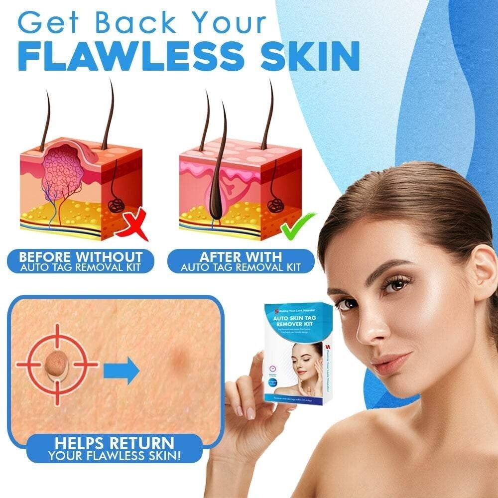 🔥auto micro skin tag remover