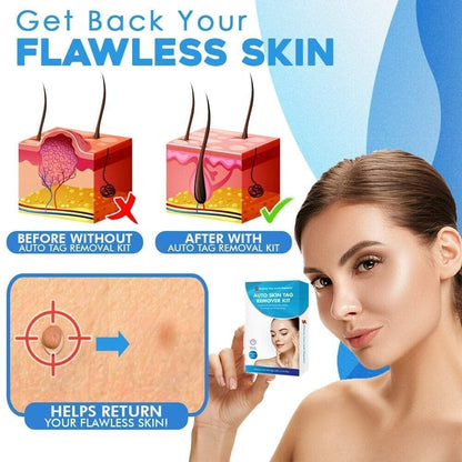 🔥auto micro skin tag remover