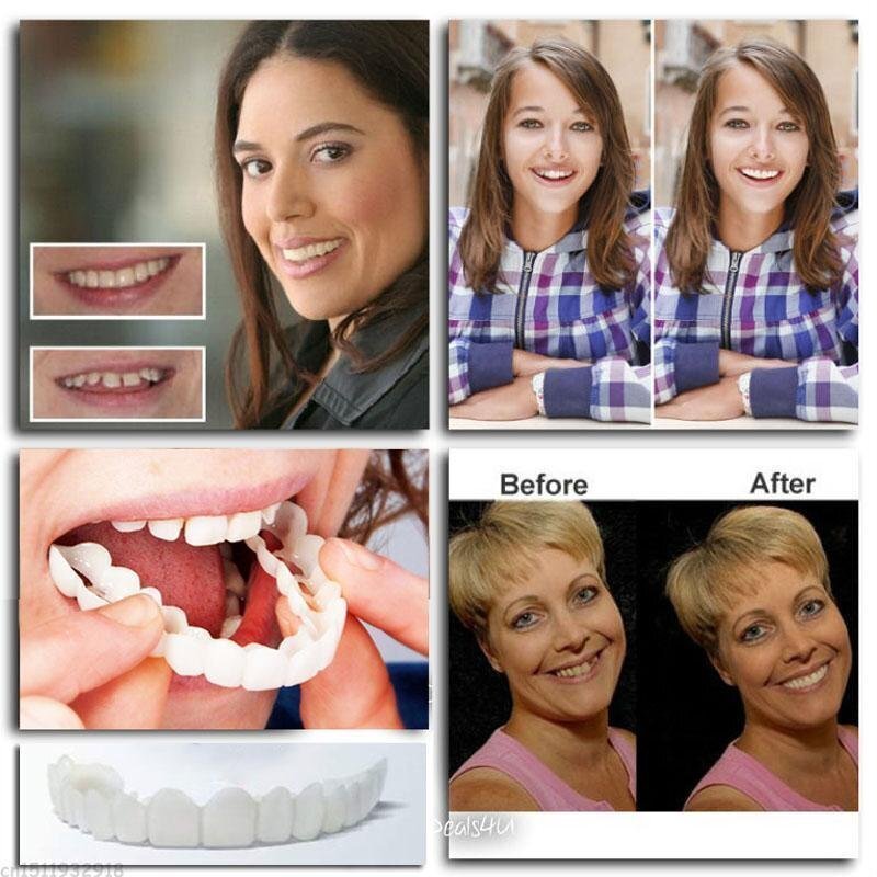 🎉Snap-On Dentures