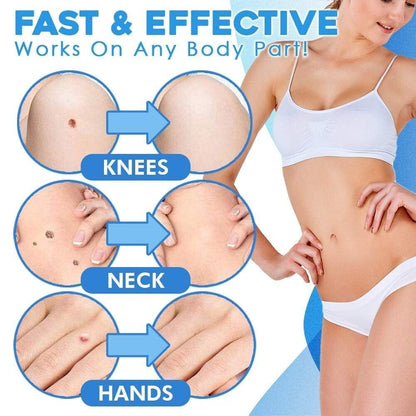 🔥auto micro skin tag remover