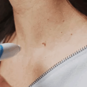 🔥auto micro skin tag remover